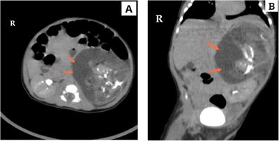 Case Report: A rare case of antenatally diagnosed mature adrenal teratoma in an infant: insights and literature review